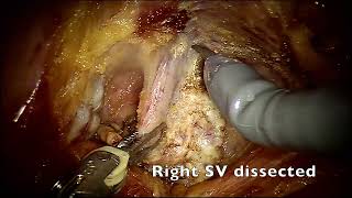 Nerve sparing Robotic Assisted Radical Prostatectomy final Full video [upl. by Mattias]