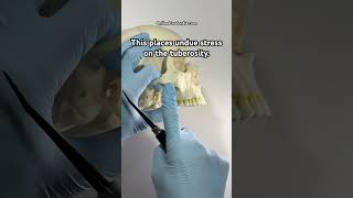 💀 How To Break The Tuberosity  OnlineExodontiacom  dentaltips dentist [upl. by Augustin]