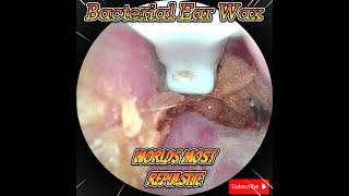 Bacterial pusheavily infected ear clean outWARNINGVile content [upl. by Shabbir45]