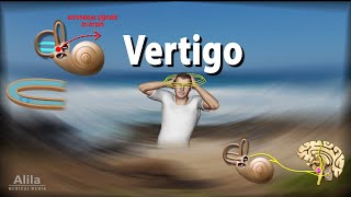 Vertigo Causes Pathophysiology and Treatments Animation [upl. by Hepzi]