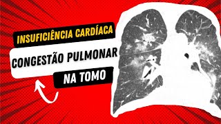 INSUFICIÊNCIA CARDÍACA CONGESTIVA determinando CONGESTÃO PULMONAR na tomografia de tórax [upl. by Macmullin]