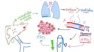 Hepatopulmonary syndrome [upl. by Yrocej]