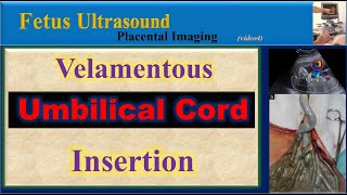 Fetus Ultrasound Velamentous Umbilical Cord Insertion [upl. by Lewert855]