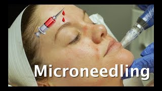 MICRONEEDLING  BEFORE amp AFTER  EVERYTHING YOU NEED TO KNOW [upl. by Quita]