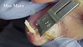 Mss Mara Ep15  Liberating nail cleaning for trapped dirt repairing Podología Integral [upl. by Padriac]