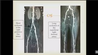 Capsule 9 Obliterative arteriopathy of the lower limbs  Dr Zaki Khadija [upl. by Hughes]