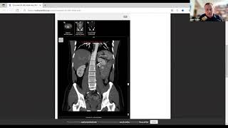 Vascular Anomalies IVC [upl. by Egidius229]