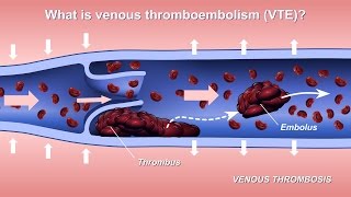 Understanding and Diagnosing Venous Thromboembolism VTE [upl. by Aicsile]