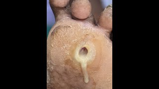 Callus Ulcer Turned Diabetic Foot case Before After Video shorts [upl. by Salome]