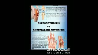 OsteoarthritisOsteoarthritis shorts youtubeshort viral shortfeedclips [upl. by Dickie]