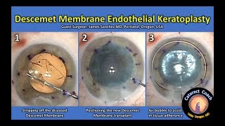 DMEK Descemet Membrane Endothelial Keratoplasty Corneal transplant of the inner layer [upl. by Silvester]