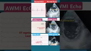 Comparison of ant wall myocardial infarction with inf wall myocardial infarction in echo and ECG [upl. by Nahttam]