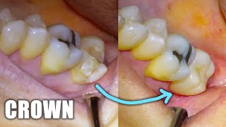 Full Dental Crown Procedure on Molar Tooth Preparation Walkthrough Placement amp Before and After [upl. by Gitt]