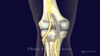 Peroneal and Tibial Intraneural Ganglion Cysts in the Knee Region Video 2 [upl. by Ecnesse]