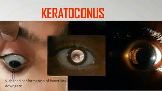 keratoconus A video compilation of munson sign rizzuti sign oil droplet reflex [upl. by Narej]