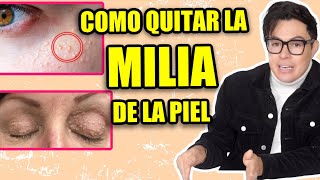 Como Quitar La Milia De La Piel ¿Porque Sale [upl. by Nneb]