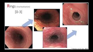 Endoscopic features of Eosinophilic Esophagitis ESNM Teaching Video [upl. by Ahsieym394]