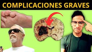 9 COMPLICACIONES GRAVES con DIABETES Mucho cuidado [upl. by Euqnomod]