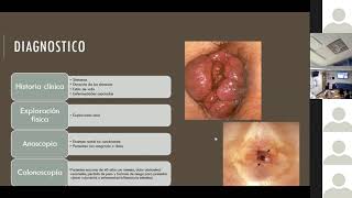 Enfermedad hemorroidal y fisuras anales [upl. by Waldo993]