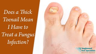 Does a Thick Toenail Mean I Have to Treat a Fungus Infection [upl. by Vashti]