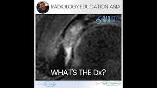 WHATS THE DX HIP MRI LABRUM MUCOID DEGENERATION [upl. by Boiney285]