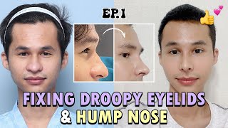 SUB HUMPECTOMY WITH TIP PLASTY amp PTOTIS CORRECTION REVIEW VLOG  PLASTIC SURGERY EXPERIENCE KOREA [upl. by Esidarap]