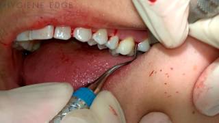 Gracey Instrumentation During Periodontal Therapy [upl. by Adnarym]