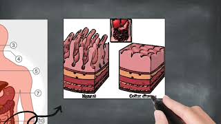 Coeliac Disease PBD [upl. by Essilrahc798]