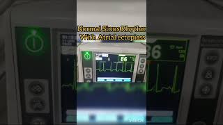 Normal Sinus Rhythm with Atrial Ectopic beats ecg cardiology [upl. by Diarmit602]