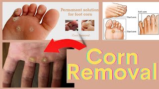 Corn Removal Treatment on the Hand amp foot  Corn Removal by Laser [upl. by Anitneuq]