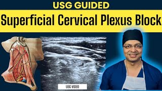 USG GUIDED SUPERFICIAL CERVICAL PLEXUS BLOCK  Cervical plexus anatomy  Real USG video of BLOCK [upl. by Fredra]