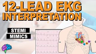 HOWTO Recognize STEMI Mimics on 12Lead EKG [upl. by Freberg344]