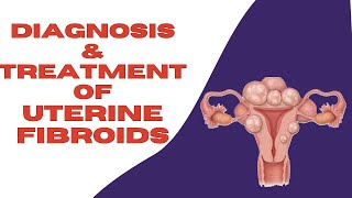 What Are The Treatments For Uterine Fibroids  How To Get Rid of Fibroids [upl. by Eecyal503]