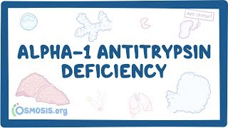 Alpha1 Antitrypsin Deficiency  causes symptoms diagnosis treatment pathology [upl. by Namrej734]