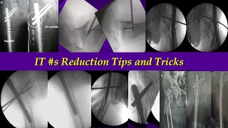 Reduction of Inter Trochanteric Fracture Neck Femur [upl. by Roland]