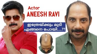 Next quotOnamquot with full hair Actor Aneesh Ravi weakest Donor Area Hair Transplantation [upl. by Yenor628]