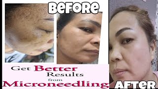 BEFORE AND AFTER MICRONEEDLING EXPERIENCE ¦MY 4th SESSIONMY NATIRA PA😁 microneedling [upl. by Naujtna]