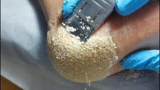 This is for lover of cheese Cracked heel treatment amp Callus removal Dead skin removal Foot care [upl. by Newo613]