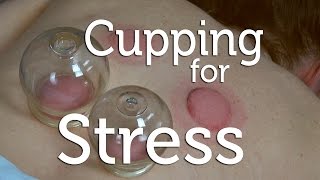 How Does Cupping Reduce Stress [upl. by Ecilegna]