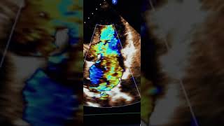 Mitral valve prolapse of the posterior leaflet see description [upl. by Elbys367]