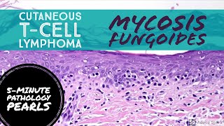 Mycosis Fungoides Cutaneous TCell Lymphoma 5Minute Pathology Pearls [upl. by Nisotawulo]