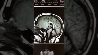 Cribriform plate meningioma [upl. by Anelac]