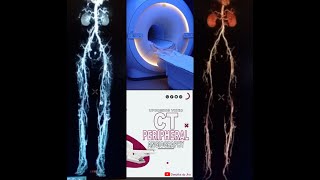 CT Peripheral angiography on Philips 128 slice [upl. by Onairelav]