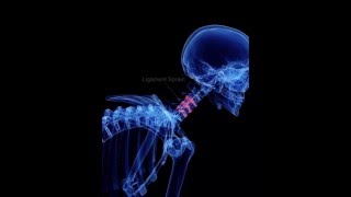 Cervical Ligament Sprain [upl. by Damian]