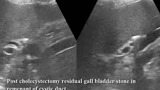 Case 519 Post cholecystectomy syndrome PCS residual gall bladder stone in remenant of cystic duct [upl. by Chicoine]