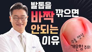 발톱을 일자로 깎아야 하는 이유내성 발톱의 원인 예방하는 방법 셀프 케어 방법 실제 수술 영상 포함 [upl. by Angela]