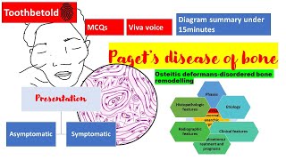 Pagets disease of bone  RadiographHISTOPATHOLOGYclinical features  NBDENEET MDSBDS  Diagrams [upl. by Ahsaele]