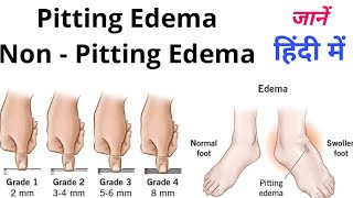 Types Of Edema  Pitting EdemaNon Pitting Edema सूजन के प्रकार और इलाज [upl. by Sykes]