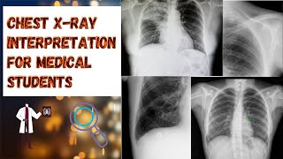 Chest XRay Interpretation for Medical Students  ABCDE approach [upl. by Siddra]