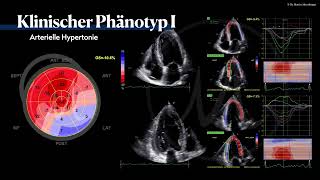 〖Echokardiografie〗 Arterielle Hypertension  HFpEF Phänotyp🫀 [upl. by Pulcheria614]